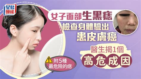 痣是凸的|是痣or皮膚癌？醫「1張圖秒對照」 長這2部位最危險